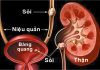 Sỏi bàng quang và sỏi niệu quản.
