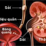Sỏi bàng quang và sỏi niệu quản.