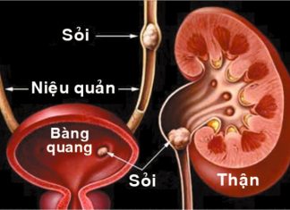 Sỏi bàng quang và sỏi niệu quản.