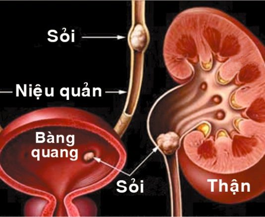 Bệnh sỏi tiết niệu và sỏi thận.