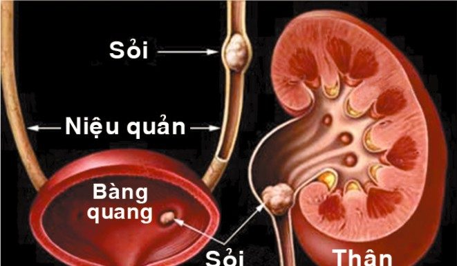 Bệnh sỏi tiết niệu và sỏi thận.