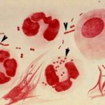 Viêm âm đạo do vi khuẩn và viêm cổ tử cung mủ nhầy do lậu.