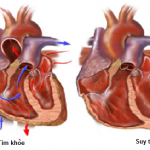 Nghiên cứu đại thể bệnh thấp tim mãn.