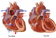 Diễn biến lâm sàng của viêm nội tâm mạc nhiễm khuẩn.