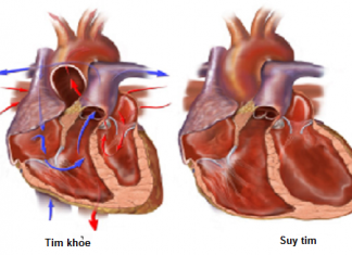 Nghiên cứu đại thể bệnh thấp tim mãn.