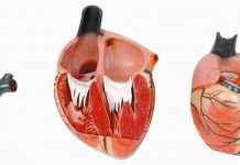 Nghiên cứu đại thể bệnh viêm nội tâm mạc nhiễm khuẩn.