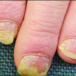 Biểu hiện bệnh vảy nến