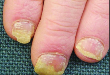 Biểu hiện bệnh vảy nến