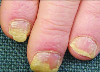 Biểu hiện của nấm móng