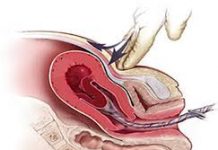Một số điều cần biết về chảy máu sau sinh do đờ tử cung