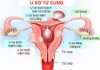 Đại thể, vi thể và tiến triển của u.