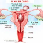 Đại thể, vi thể và tiến triển của u.