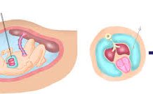Một số bài thuốc nam chữa nôn mửa trong cộng đồng