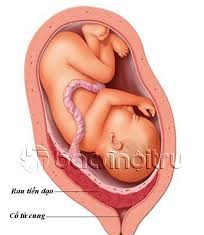 Những điều cần biết về các phương pháp xử trí rau tiền đạo
