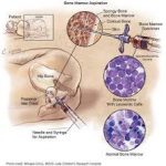 Điều trị và phòng hội chứng bong vảy da do tụ cầu