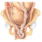 Một số điều chị em cần chú ý về đẻ khó do sa dây rau trong chuyển dạ