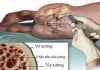 Một số điều cần biết về bệnh đa u tủy xương
