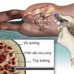 Một số điều cần biết về bệnh đa u tủy xương