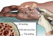 Một số điều cần biết về bệnh đa u tủy xương