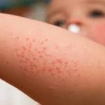 Ảnh hưởng của bệnh do Toxoplasma đến mẹ và thai