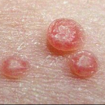 Điều trị bệnh u mềm lây