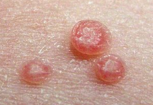 Điều trị bệnh u mềm lây