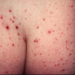 Biểu hiện bệnh Lichen phẳng