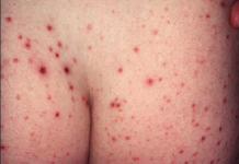 Bệnh vảy phấn dạng lichen