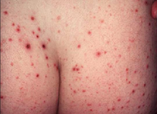 Biểu hiện bệnh Lichen phẳng