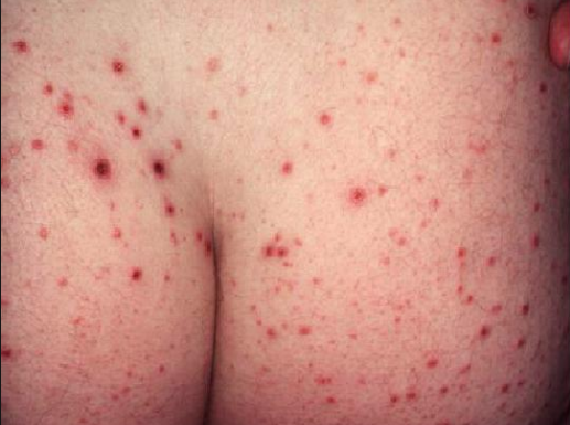 Biểu hiện bệnh Lichen phẳng