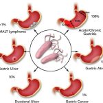 BỆNH NGUYÊN LOÉT DẠ DÀY TÁ TRÀNG