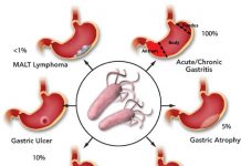 BỆNH NGUYÊN LOÉT DẠ DÀY TÁ TRÀNG