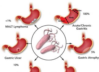 BỆNH NGUYÊN LOÉT DẠ DÀY TÁ TRÀNG