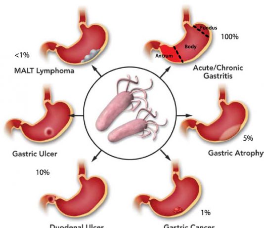 BỆNH NGUYÊN LOÉT DẠ DÀY TÁ TRÀNG