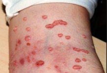 Biểu hiện bệnh u mềm lây