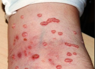 Biểu hiện bệnh u mềm lây