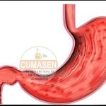 Triệu chứng lâm sàng viêm dạ dày cấp