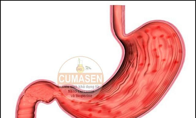 Triệu chứng lâm sàng viêm dạ dày cấp