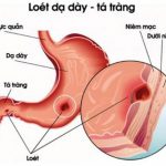 BỆNH SINH LOÉT DẠ DÀY TÁ TRÀNG