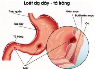 BỆNH SINH LOÉT DẠ DÀY TÁ TRÀNG