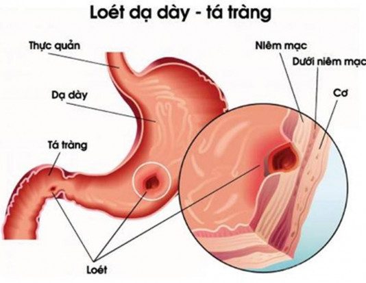BIẾN CHỨNG CỦA LOÉT DẠ DÀY TÁ TRÀNG