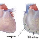 Bệnh sinh bệnh viêm nội tâm mạc nhiễm khuẩn.