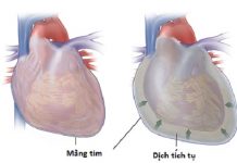 Bệnh sinh bệnh viêm nội tâm mạc nhiễm khuẩn.