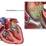 Nghiên cứu vi thể bệnh viêm nội tâm mạc nhiễm khuẩn.