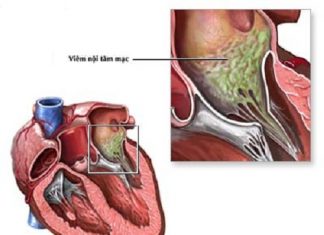 Nghiên cứu vi thể bệnh viêm nội tâm mạc nhiễm khuẩn.
