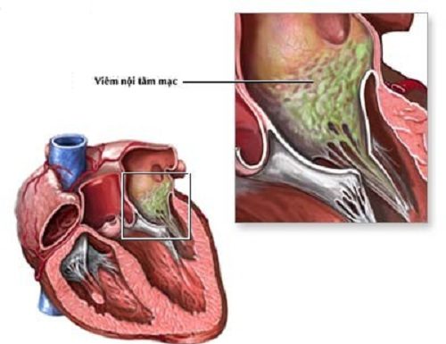Nghiên cứu vi thể bệnh viêm nội tâm mạc nhiễm khuẩn.