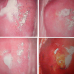 Phân biệt bệnh nấm do Candida