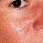 Biểu hiện bệnh viêm bì cơ bệnh viêm bì cơ