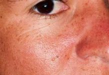 Biểu hiện bệnh viêm bì cơ bệnh viêm bì cơ