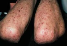 Phân biệt và điều trị bệnh viêm da dạng herpes của Duhring-Brocq viêm da dạng herpes